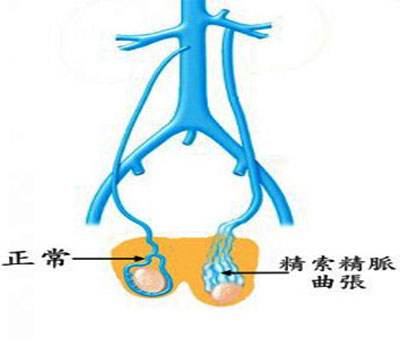 精索靜脈曲張微創(chuàng)手術(shù)費(fèi)用多少